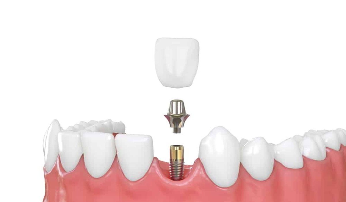 How long does it take to get dental implants?
